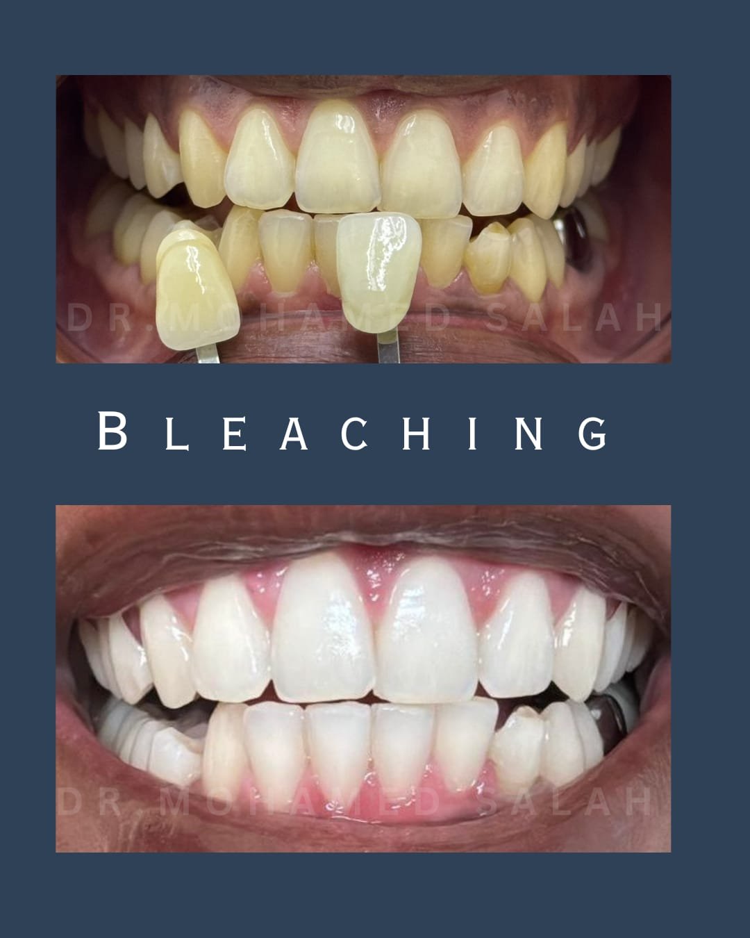 teeth whitening in abudhabi Nano teeth brighening