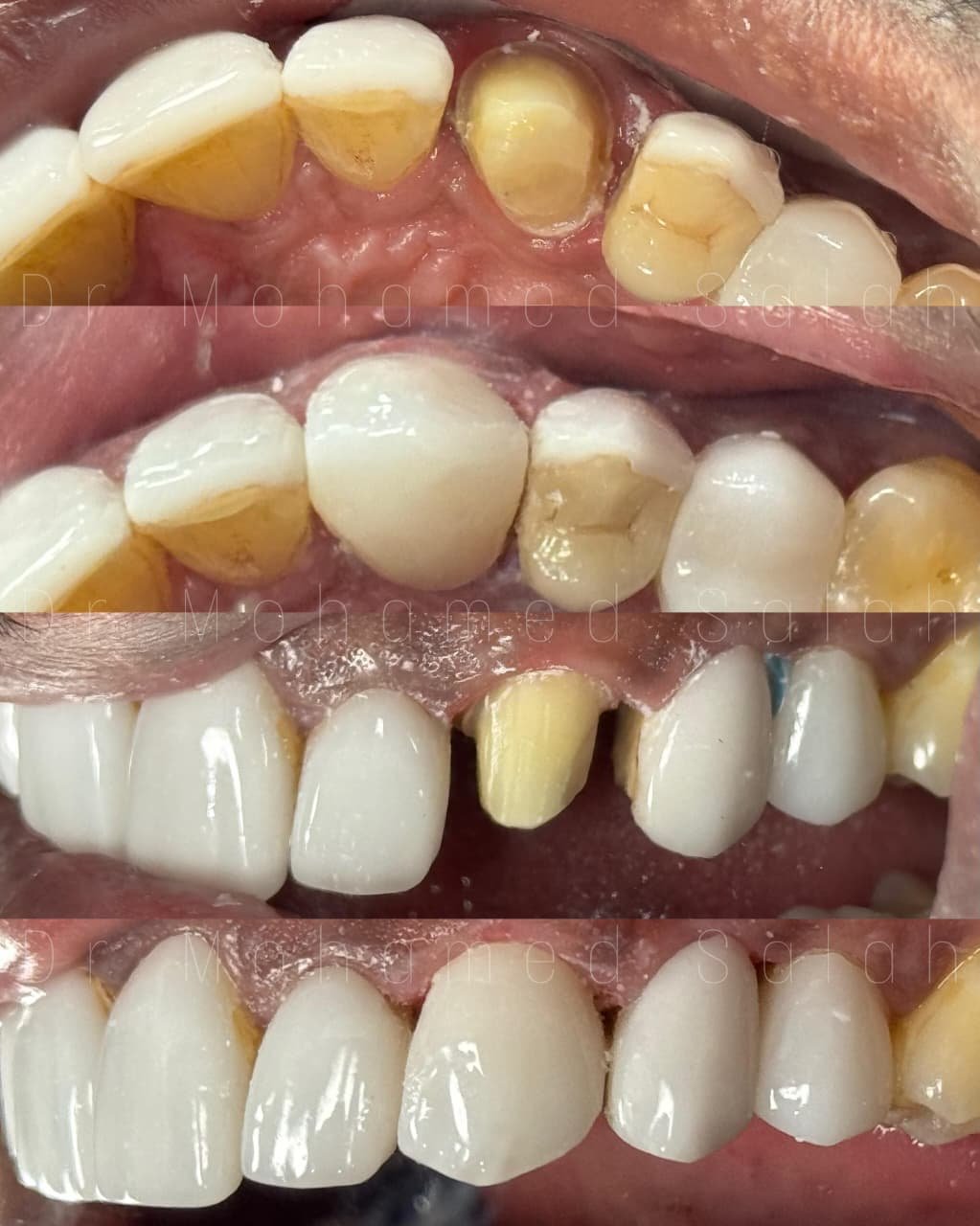 tooth crown in abudhabi