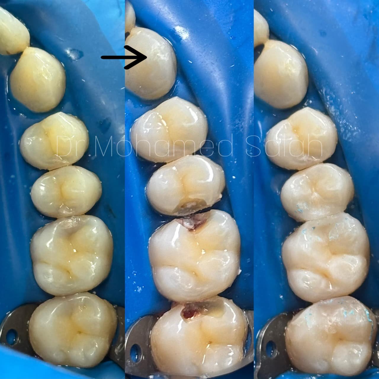 filling in abudhabi